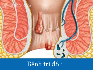 Trĩ độ 1