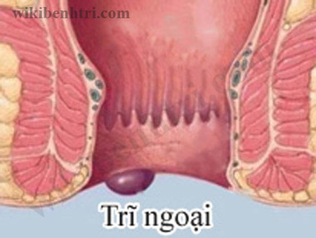 Bệnh trĩ ngoại