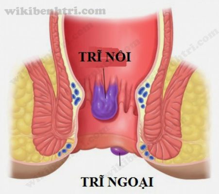 Bệnh trĩ