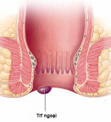 Bệnh trĩ ngoại Bệnh trĩ ngoại