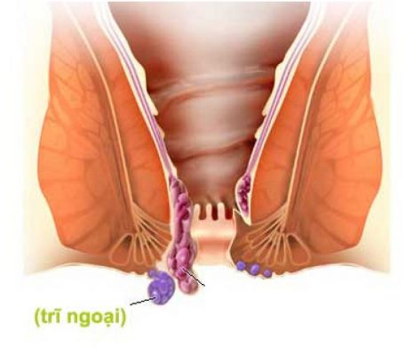 Bệnh trĩ ngoại Bệnh trĩ ngoại
