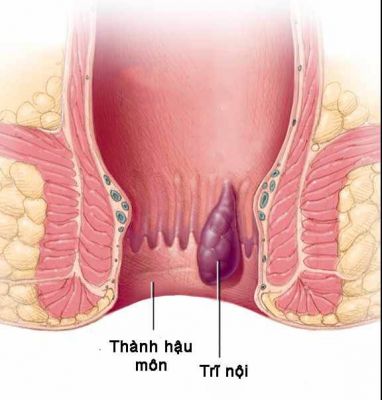 Bệnh trĩ nội Bệnh trĩ nội