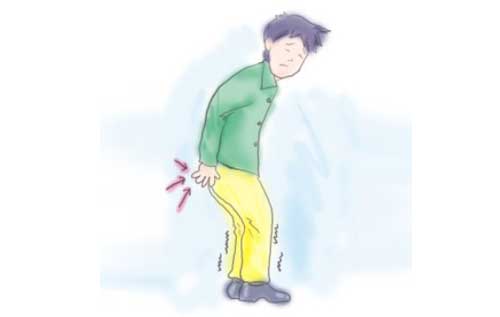 Biểu hiện polyp hậu môn