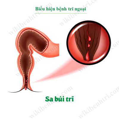 Biểu hiện bệnh trĩ ngoại