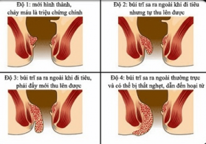 Các cấp độ trĩ nội