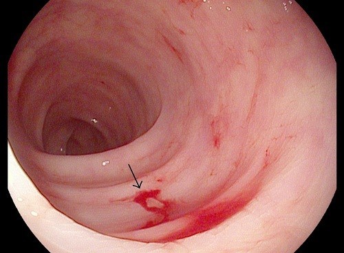 Đi ngoài ra máu cũng có thể do bị polyp hậu môn