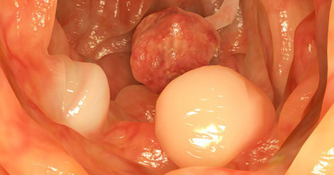 Đi ỉa ra máu là biểu hiện của bện polyp hậu môn - trực tràng Đi ỉa ra máu là biểu hiện của bện polyp hậu môn - trực tràng