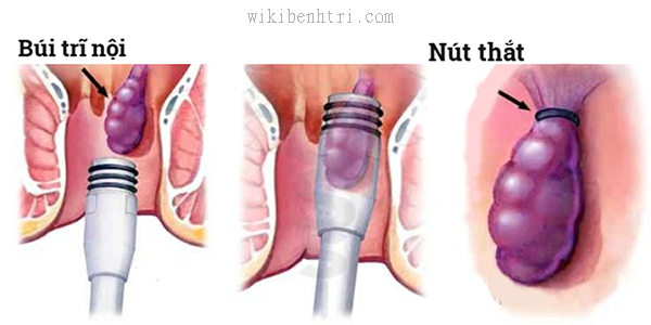 Phương pháp điều trị bệnh trĩ bằng thắt vòng cao su