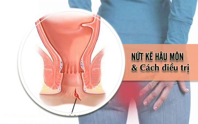 Cách điều trị nứt kẽ hậu môn Cách điều trị nứt kẽ hậu môn