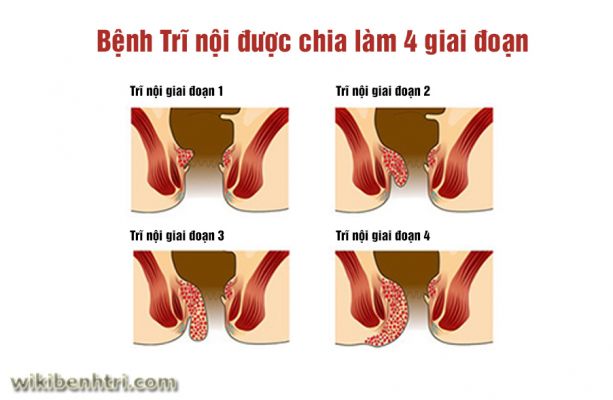 Các giai đoạn của bệnh trĩ nội Các giai đoạn của bệnh trĩ nội