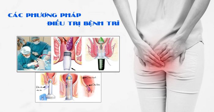 Các phương pháp điều trị bệnh trĩ