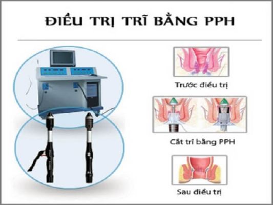 Phương pháp PPH điều trị bệnh trĩ hiệu quả