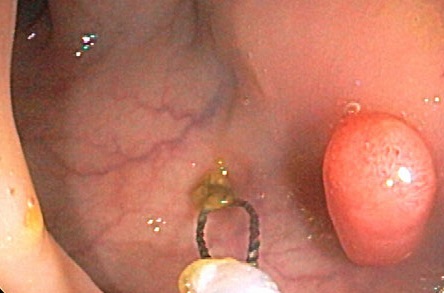 Polyp hậu môn