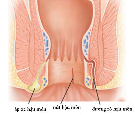 Rò hậu môn