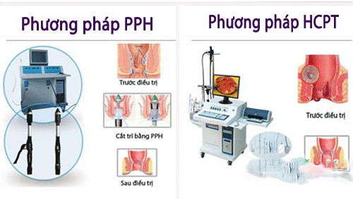 Các phương pháp chữa và điều trị bệnh trĩ