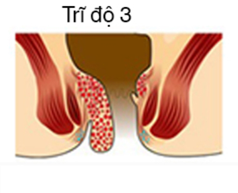 Sự nguy hiểm của trĩ độ 3 tới người bệnh