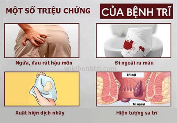 Cách nhận biết bệnh trĩ qua triệu chứng bệnh trĩ