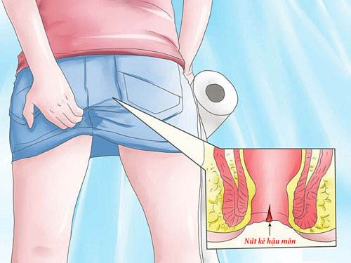 Triệu chứng nứt kẽ hậu môn