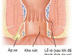 Tìm hiểu thêm: những vấn đề liên quan đến apxe hậu môn