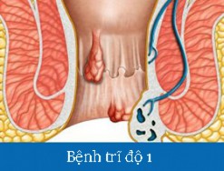 Trĩ độ 1 là gì? Các biện pháp khắc phục trĩ độ 1 như thế nào