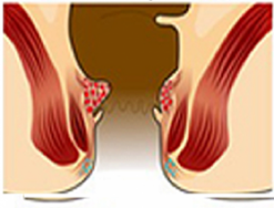Bệnh trĩ giai đoạn đầu và những cách chữa và điều trị