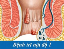 Trĩ nội độ 1 gây ảnh hưởng gì tới đời sống người bệnh