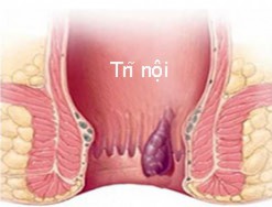 Trĩ nội là gì? Tại sao lại bị trĩ nội?