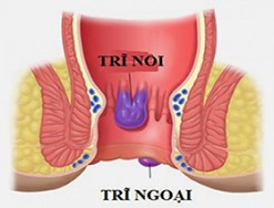 Trĩ nội và trĩ ngoại có những điểm giống và khác nhau như thế nào?