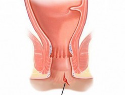 Nứt kẽ hậu môn là gi? Có biểu hiện bệnh như thế nào