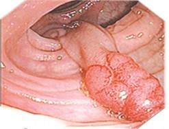 Cùng tìm hiểu thêm về bệnh polyp hậu môn