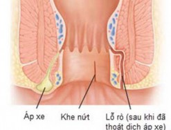 Rò hậu môn có tự khỏi được không? Rò hậu môn có những triệu chứng gì?