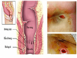 Tại sao lại bị rò hậu môn, cách chữa rò hậu môn như thế nào?