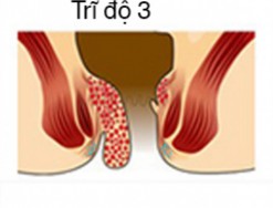Bệnh trĩ cấp độ 3 gây ra rất nhiều biến chứng nguy hiểm
