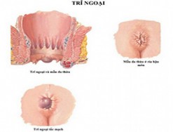 Trĩ ngoại độ 1 có ảnh hưởng gì và cách điều trị như thế nào hiệu quả