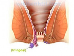 Cách làm co búi trĩ ngoại đơn giản tại nhà bạn nên biết