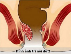 Trĩ nội độ 2 ảnh hưởng như thế nào tới đời sống người bệnh