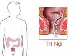 Khi bị trĩ nội có thể quan hệ qua hậu môn được không?