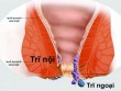 Trĩ nội, trĩ ngoại khác nhau ở điểm nào và cách nhận biết chúng