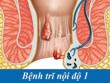 Trĩ nội độ 1 gây ảnh hưởng gì tới đời sống người bệnh
