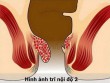 Trĩ nội độ 2 ảnh hưởng như thế nào tới đời sống người bệnh