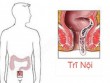 Khi bị trĩ nội có thể quan hệ qua hậu môn được không?